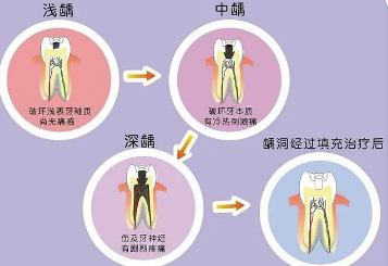 龋齿治疗方法