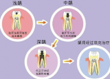 龋齿治疗方法