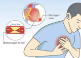 冠心病的发病原因