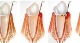 牙周炎的治疗方法