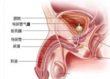 慢性前列腺炎症状