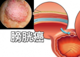 膀胱癌转移了还能活多久