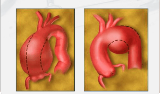 机器学习用于确定胸主动脉瘤的风险